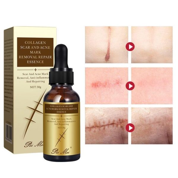 Peimei Collagen Skincare Serum Scar Removal Skin Repairing Stretch Marks Serum 30ml,Scar Repair Serum,Acne Scar Removal Serum 3