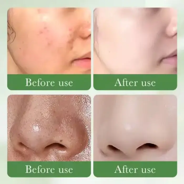 SADOER Face Cleanser, With 3% Salicylic Acid, Niacinamide & Centella Asiatica Collagen Acne Remover Facial Cleanser controls oils, Eliminates Acne kenya 3